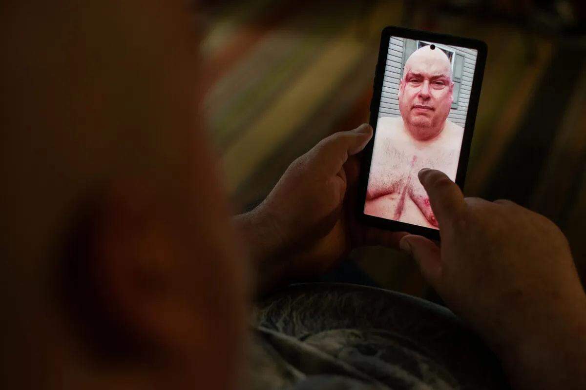 Rick Loveday, a sheriff’s deputy in a neighboring county, looks at a picture of his injuries sustained when Rankin County deputies raided his home.