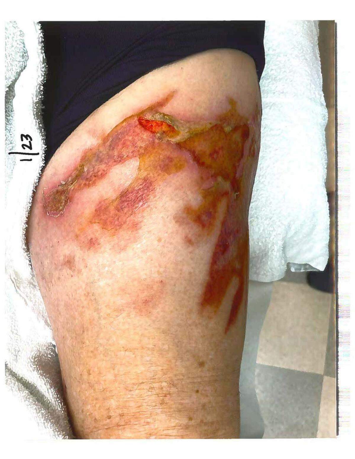 This photograph shows burns that Long Beach resident Joseph Gentry says he suffered when the lid popped off his coffee Jan. 14, 2023, in the drive-thru at the Long Beach McDonald’s on U.S. 90.