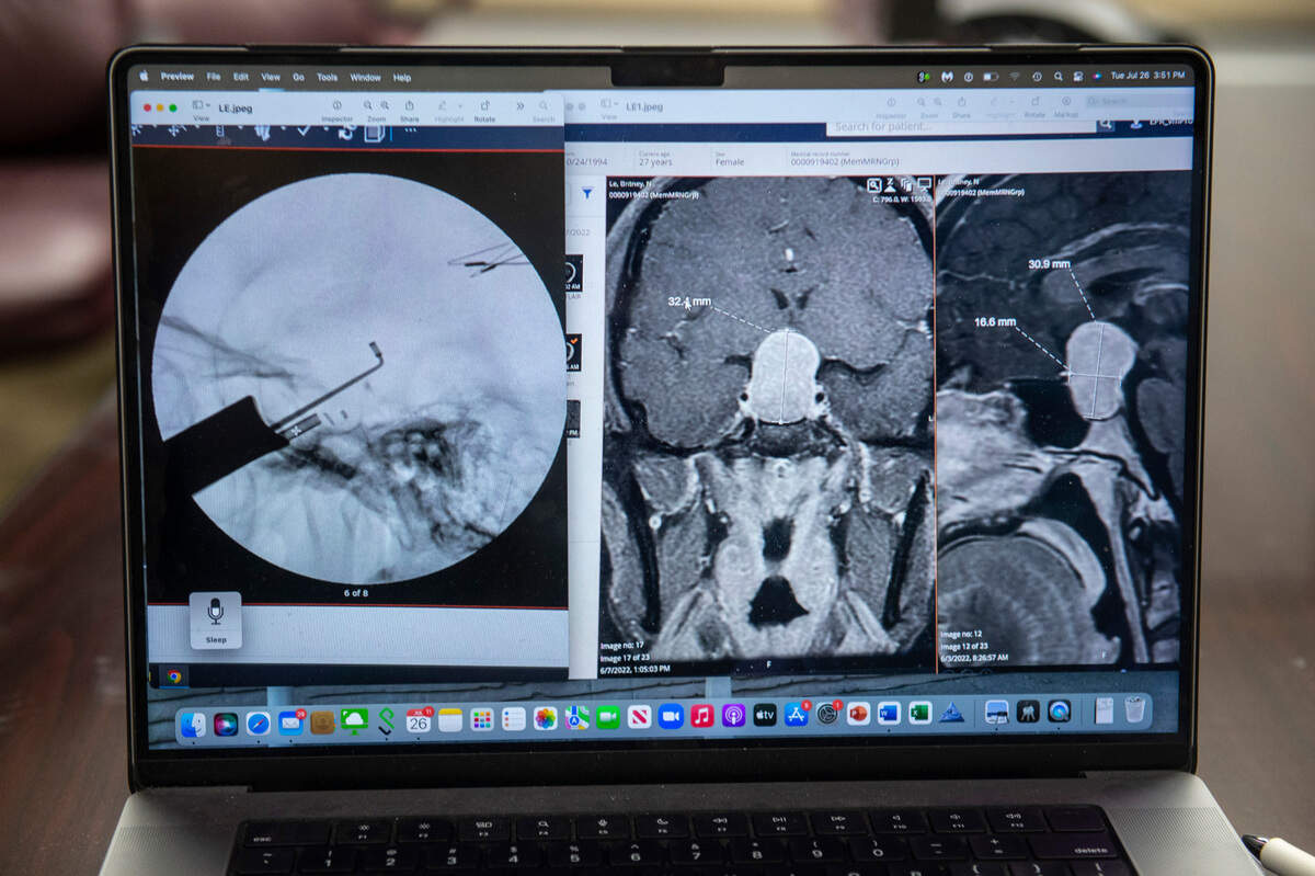 An MRI scan shows the tumor that was on Brittney Le’s pituitary gland in her brain as well as a tool used during the surgery to take out the tumor on Tuesday, July 26, 2022.