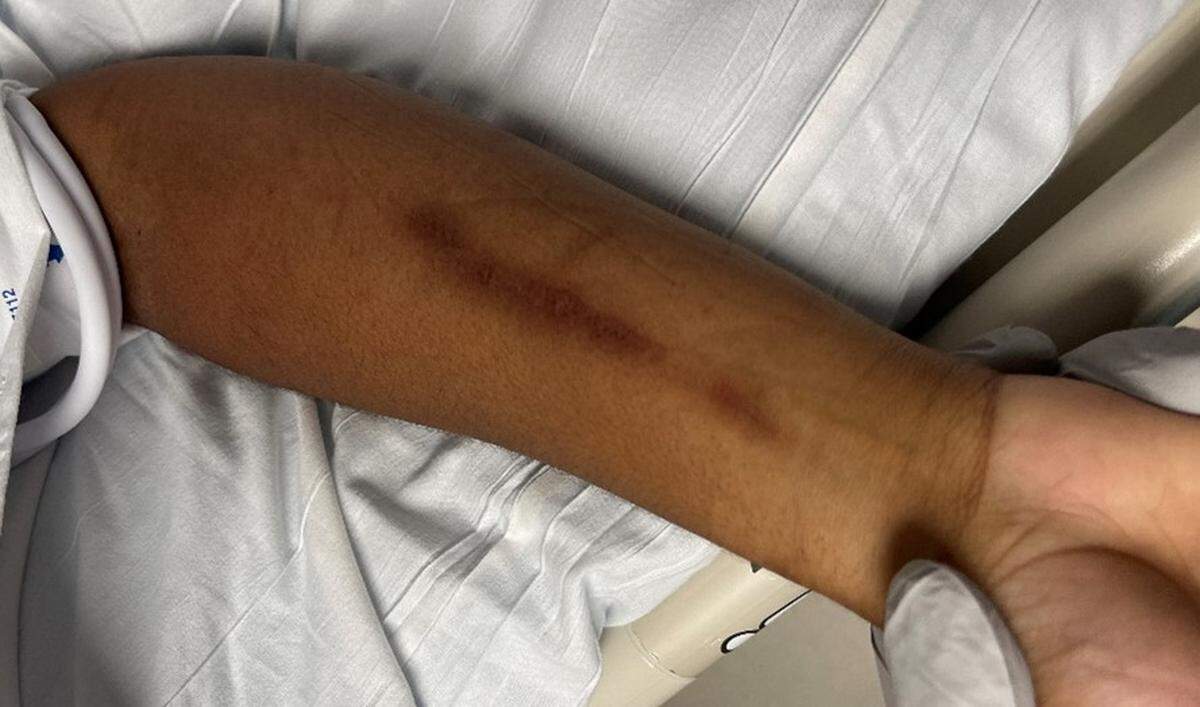 The arm of a woman only known as ‘Peaches’. The Gulfport Police Department is looking for assistance in identifying her.