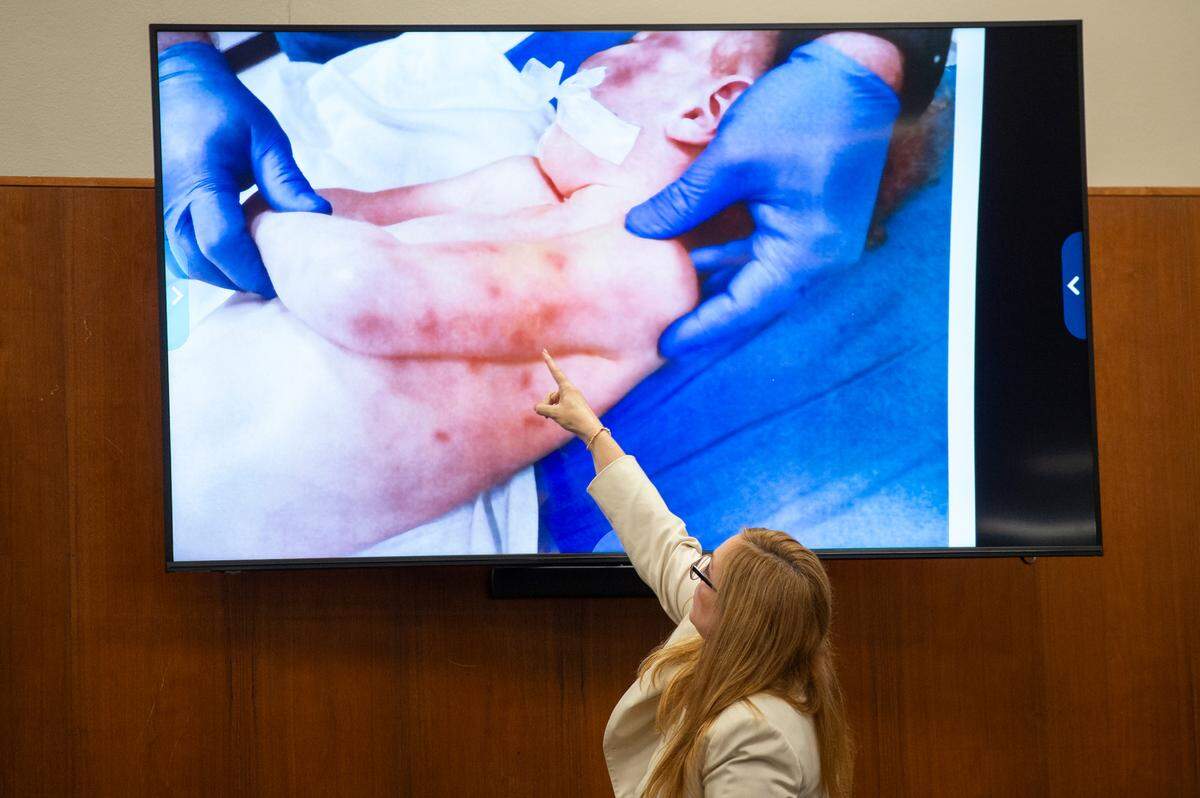 Dr. Leanne Lee points out bruising on a photo of Hayden Bataille’s body during her expert witness testimony in Joseph David Heard’s trial for capital murder in the death of Hayden Bataille in Harrison County Circuit Court in Biloxi on Wednesday, May 8, 2024.