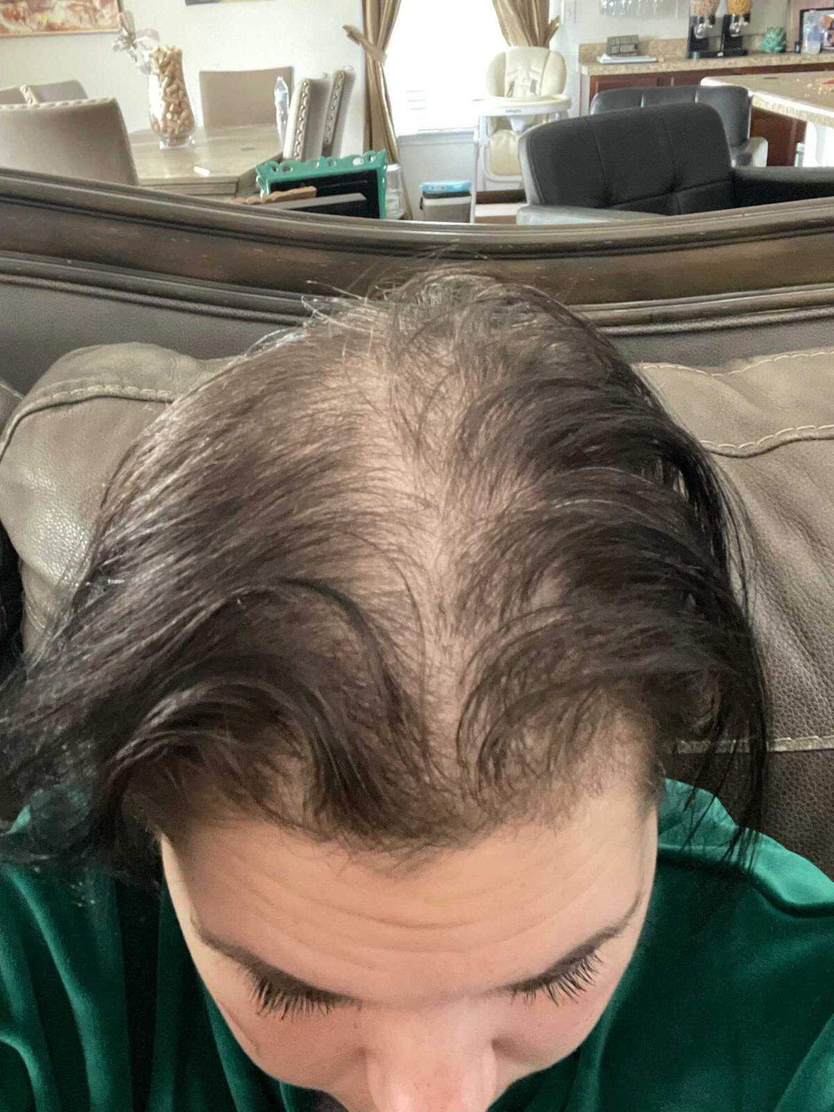 Ocean Springs resident Taylor Manning showing her hair loss, a COVID long haul symptom.