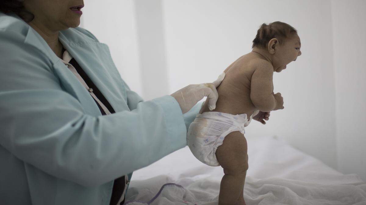 Felipe Dana/ASSOCIATED PRESSLara, who is less then three months old and was born with microcephaly, is examined by a neurologist at the Pedro I hospital in Campina Grande, Paraiba state, Brazil, Feb. 12.