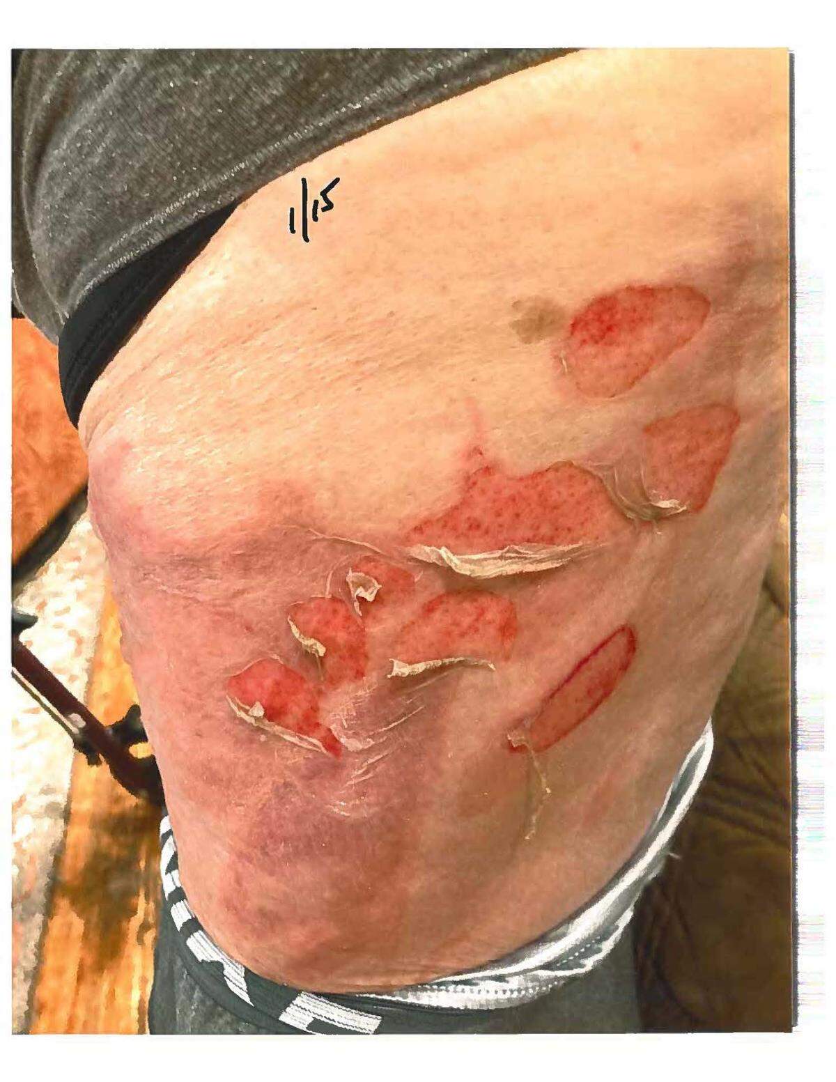 This photograph shows burns that Long Beach resident Joseph Gentry says he suffered when the lid popped off his coffee Jan. 14, 2023, in the drive-thru at the Long Beach McDonald’s on U.S. 90.