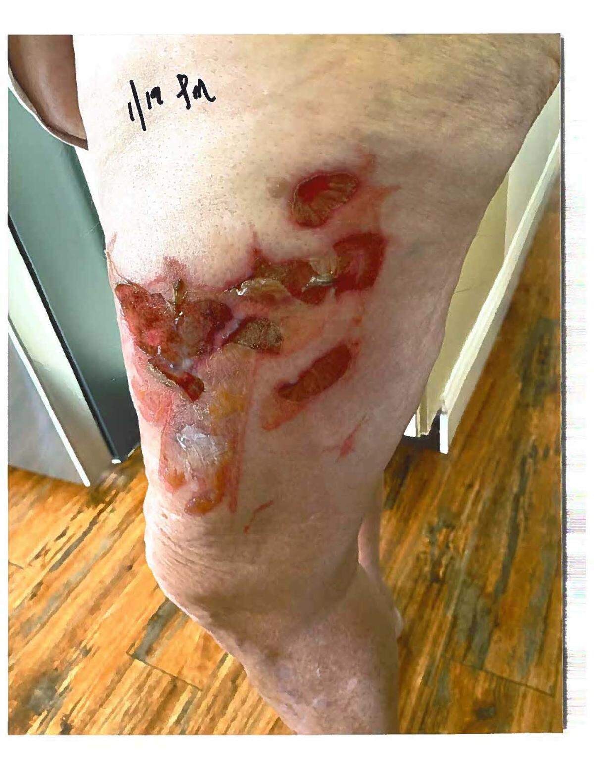 This photograph shows burns that Long Beach resident Joseph Gentry says he suffered when the lid popped off his coffee Jan. 14, 2023, in the drive-thru at the Long Beach McDonald’s on U.S. 90.