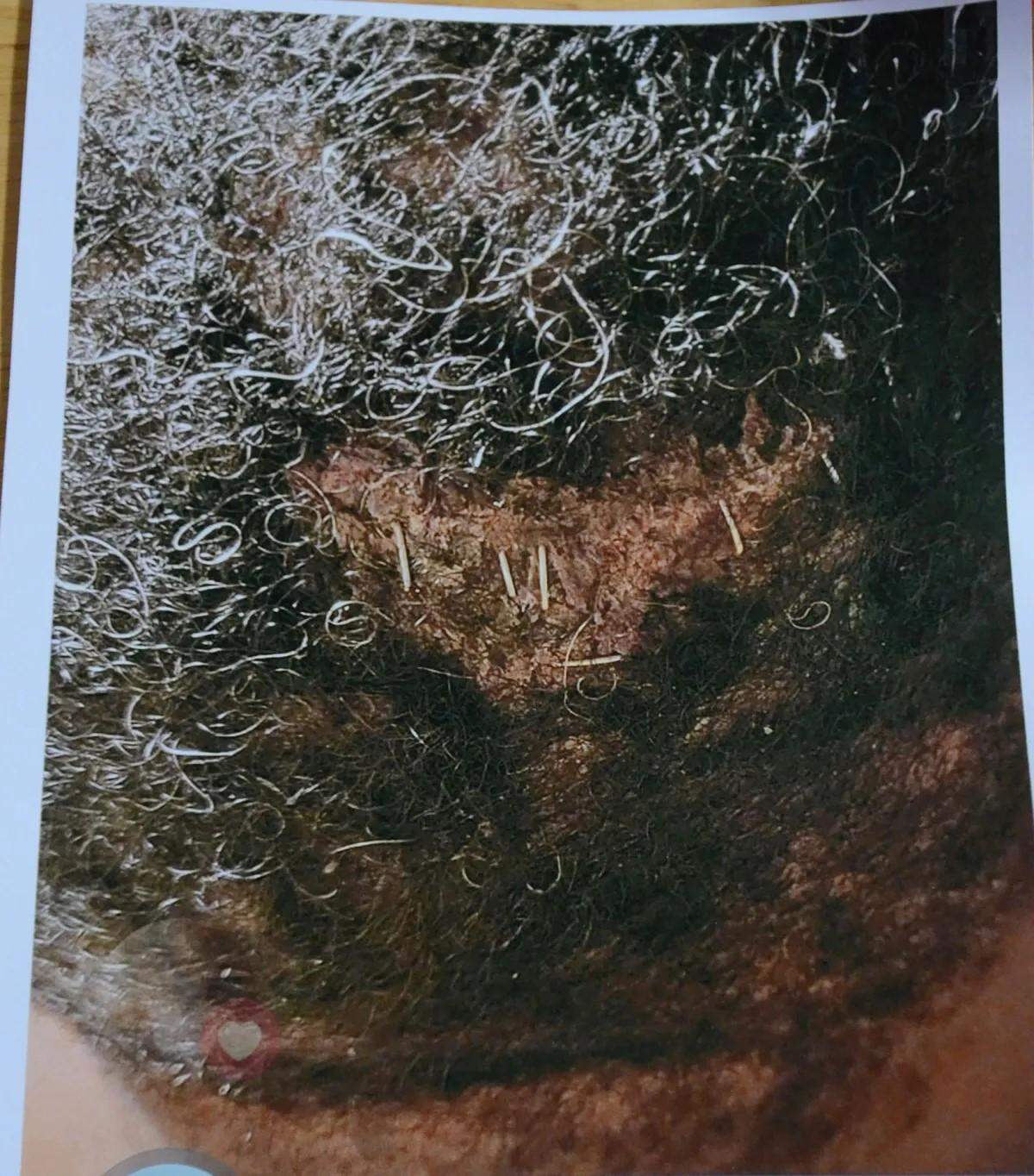 Photograph of the rear of Darryl Norwood’s head, showing the staples placed at the wound created by a stun gun.