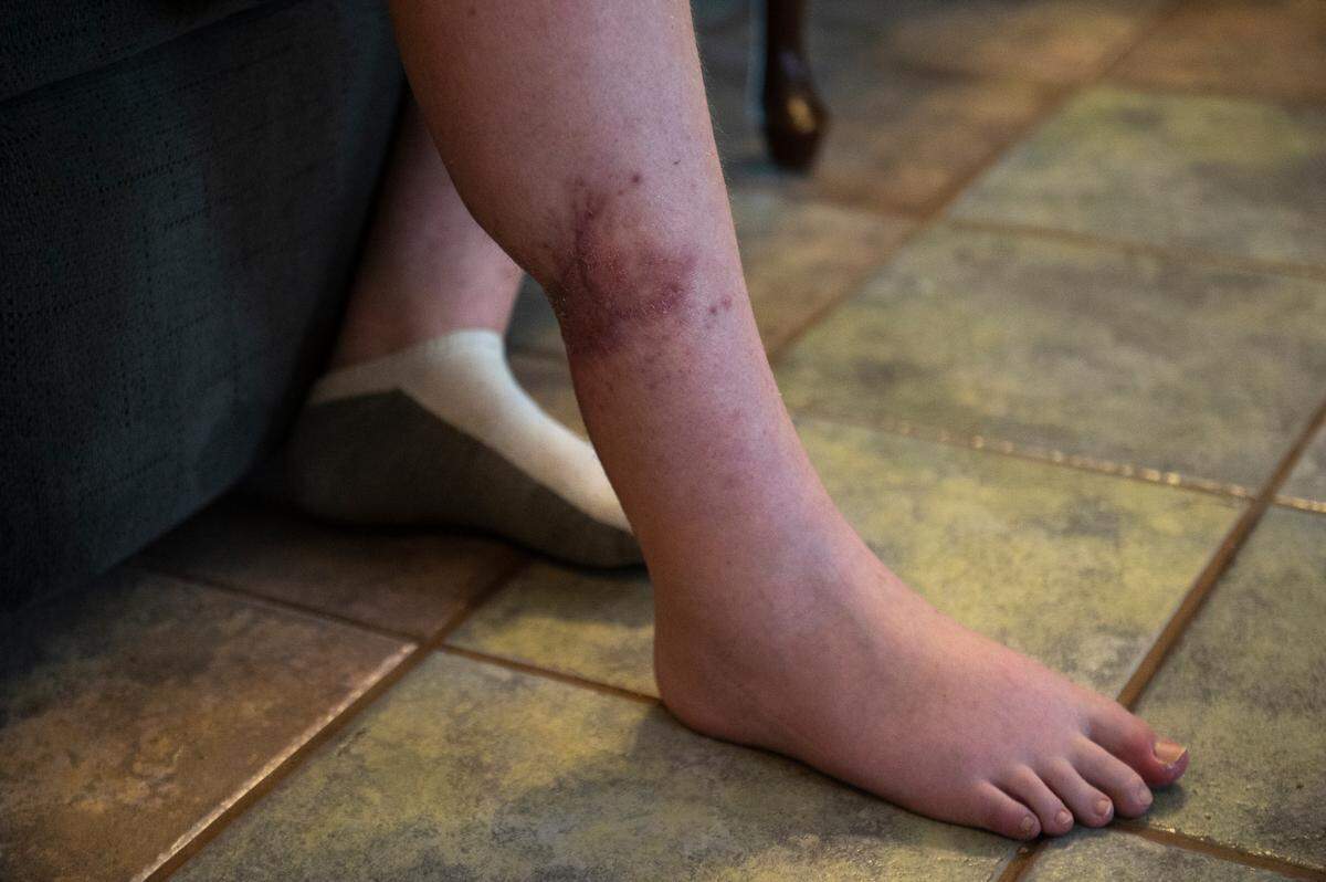 Chris McLarty, 12, shows his healing dog bite at his Jackson County home on Wednesday, June 7, 2023. Chris underwent nine surgeries and was in a wheelchair for weeks after he was severely attacked in February by a neighbor’s pit bull for the second time.