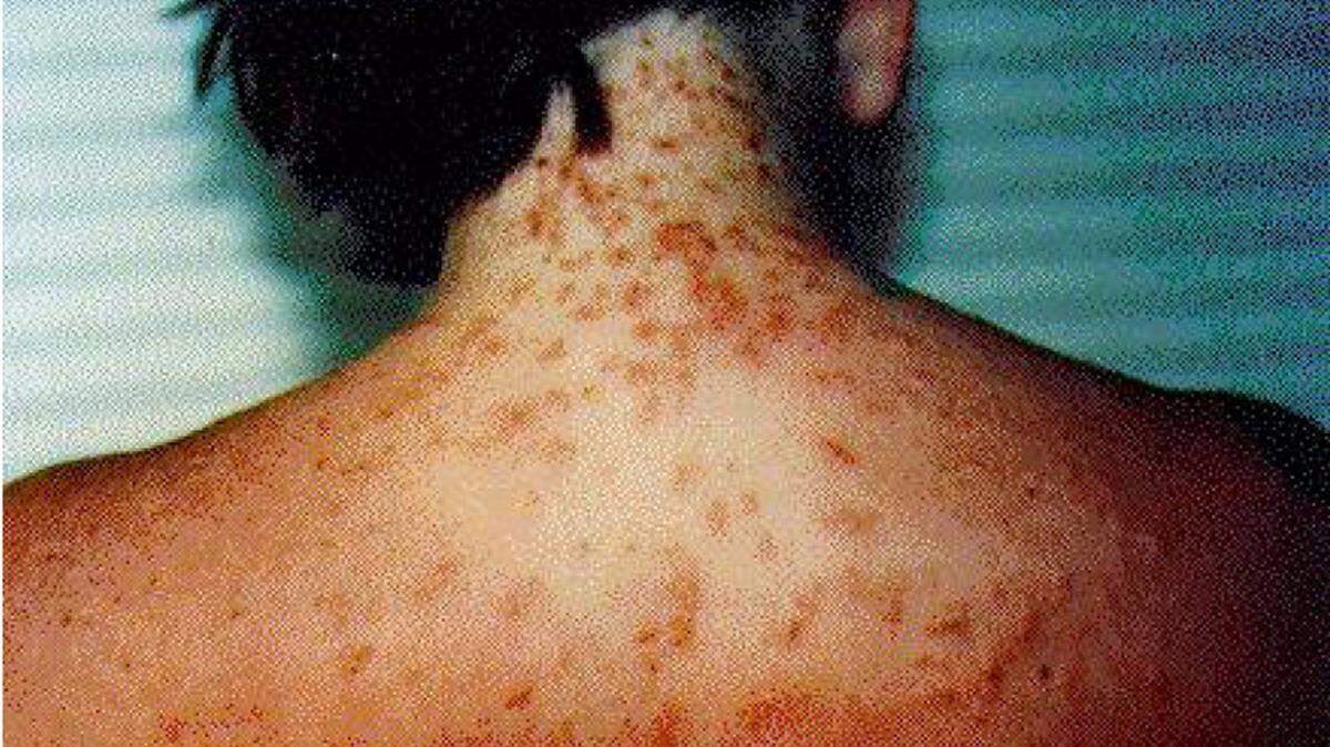 FLORIDA DEPARTMENT OF HEALTH 
 Lesions associated with seabather's eruption, which is a skin reaction to the larvae of jellyfish and sea anemones. Extended areas of rash may be caused by larvae trapped by clothing or on areas of exposed skin.