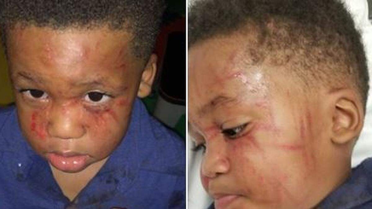 Dakota Hudson received these injuries at a Pascagoula home daycare when the operator left the children alone, Dakota’s father says.