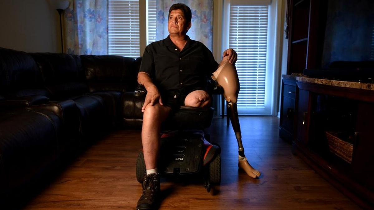 Jose Luis Ruiz, of Chattanooga, Tenn., contracted Vibrio vulnificus after eating a dozen raw oysters in December 2012. Doctors performed multiple surgeries and amputated his leg to stop the fast-moving infection. Ruiz, now 54, lost his masonry business and lives in constant pain.