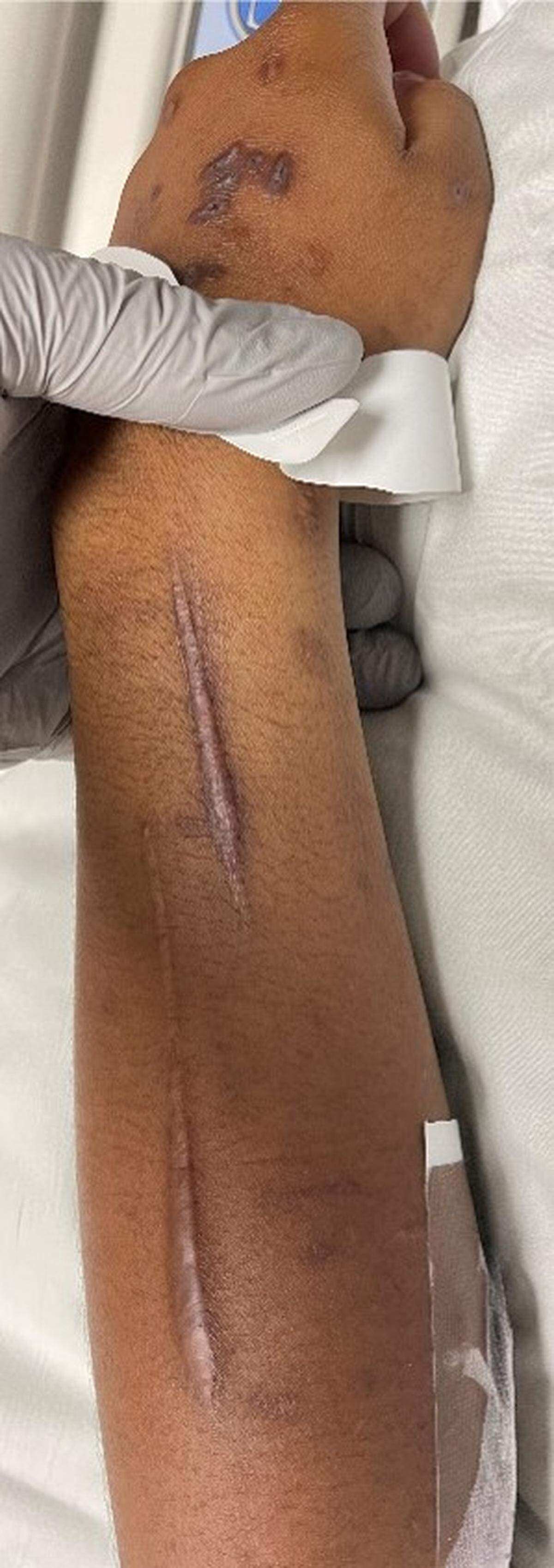 The arm of a woman only known as ‘Peaches’. The Gulfport Police Department is looking for assistance in identifying her.