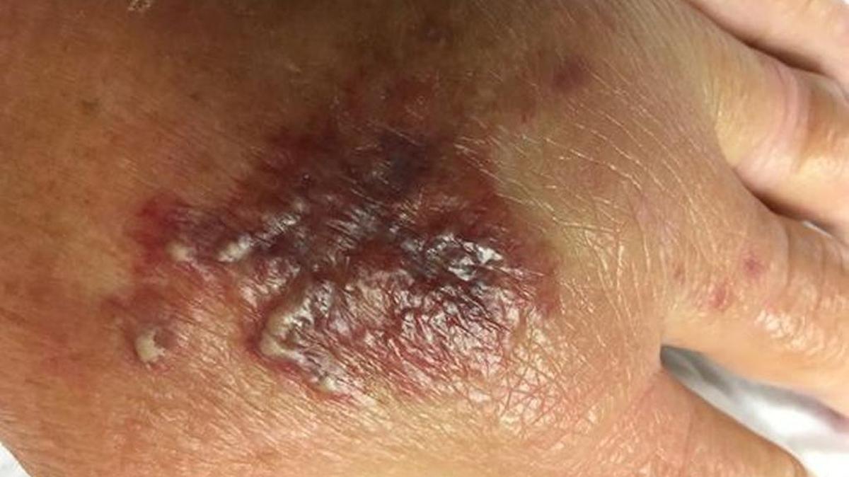 Glenda Sessions' hand after being infected with flesh-eating bacteria while on a fishing trip in the Mobile Bay.