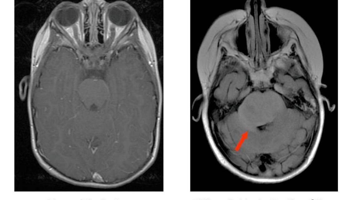 Nobody knows — not even doctors — what causes a rare brain cancer that kills children