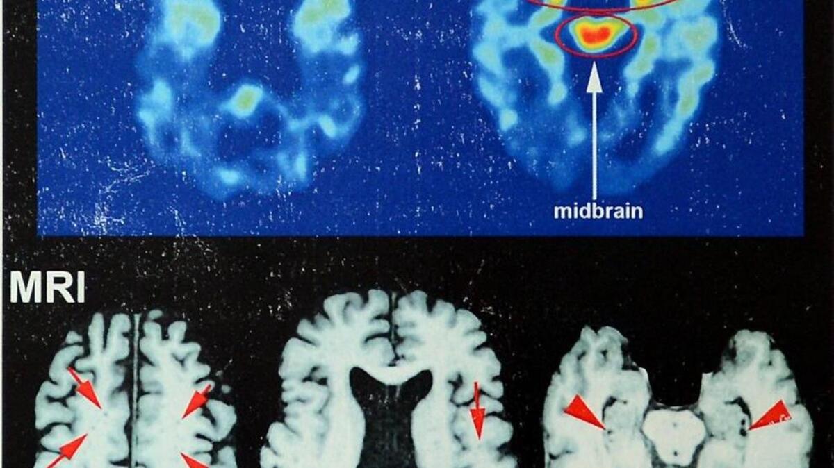 Brain scans of NFL hall of famer Joe DeLamielleure, who was diagnosed with CTE, the brain injury that is affecting so many former football players.